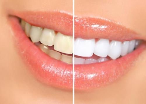 Bright White Smiles 44% Teeth Whitening Gel Syringe Refill Pack, Carbamide Peroxide, 5 Syringes (3ml),Tooth Whitener Formula-Ruum Studio Home
