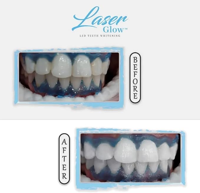 LaserGlow Professional Teeth Whitening Gel 44% Hydrogen Peroxide – Dual Barrel Syringe for Fast, Effective, and Whitening Results | Hydrogen Peroxide Gel, Teeth Whitener, Tooth Whitening Gel-Ruum Studio Home
