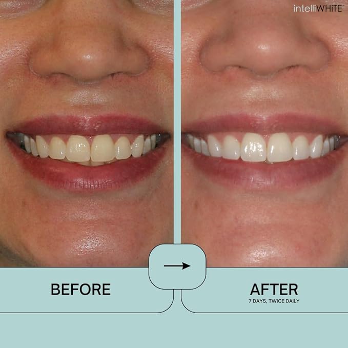 Prostrips - 12 Shades Whiter Teeth - 28 Enamel Safe REMINERALIZING Gentle Strips – 97% no Sensitivity-Ruum Studio Home