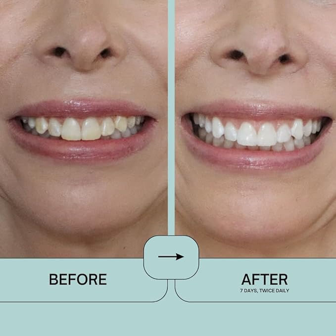 Prostrips - 12 Shades Whiter Teeth - 28 Enamel Safe REMINERALIZING Gentle Strips – 97% no Sensitivity-Ruum Studio Home
