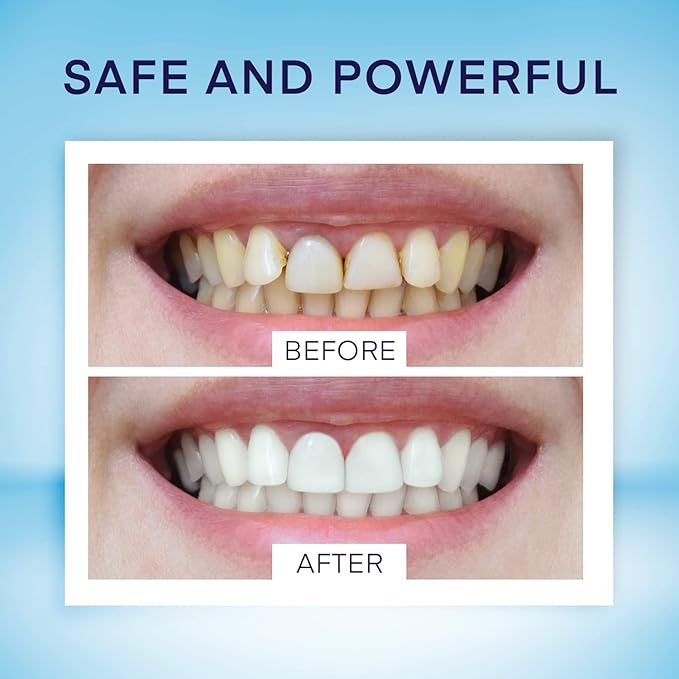 Teeth Whitening Pen (4 Pens) for Teeth Whitening, 40+ Uses, Effective, Painless, No Sensitivity, Travel-Friendly, Beautiful White Smile, Mint Flavor-Ruum Studio Home