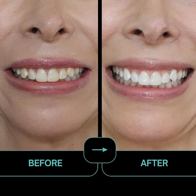 Prostrips - 12 Shades Whiter Teeth - 56 Enamel Safe REMINERALIZING Gentle Strips – 97% Had No Sensitivity - Bonus Size-Ruum Studio Home