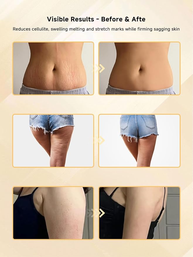 Body Sculpting Machine, Lymphatic Drainage Massager & Anti Cellulite Massage Tool, Helps Reduce Stretch Marks & Cellulite, Pain Relief Devices for Sciatica Nerve, Legs, Arms, Hip, Muscle & Lower Back-Ruum Studio Home