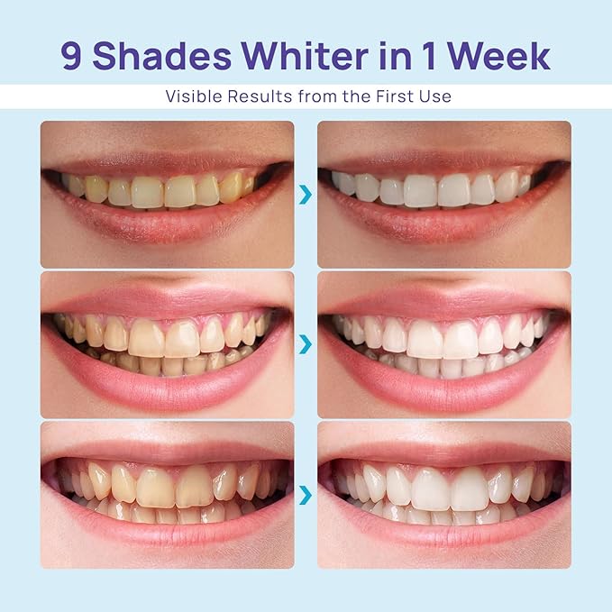 Whitebite Pro Teeth Whitening Kit for Sensitive Teeth – LED Light + 35% Carbamide Peroxide Gel + Remineralizing Gel | Dental-Grade Results at Home-Ruum Studio Home