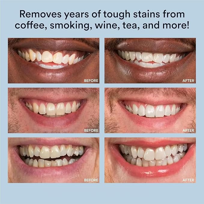 WHITE SMILE Teeth Whitening Kit, LED Light System, 35% Carbamide Peroxide 3 Gel Syringes, 10-Minute Treatment, Non-Sensitive Formula-Ruum Studio Home