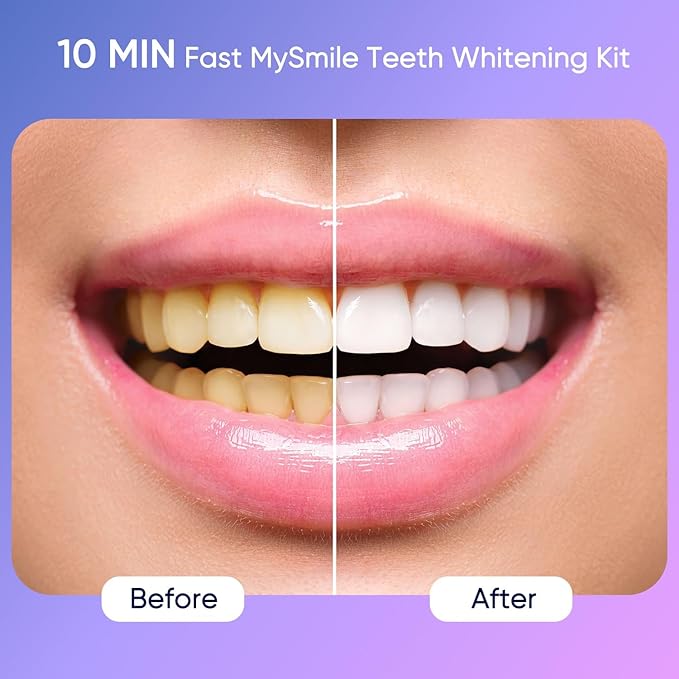 MySmile Deluxe 10 Min Teeth Whitening Kit with 28 LED Light, 35% Carbamide Peroxide Teeth Whitening Gel, Helps Remove Years of Stains from Coffee, Soda, Wines, Smoking, Food-Ruum Studio Home