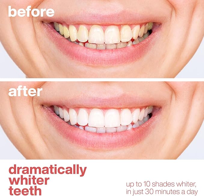 AquaSonic Professional Teeth Whitening Strips - Enamel Safe Teeth Whitening with Hydrogen Peroxide - Easy to Use, Non-Slip, Affordable & Effective (Watermelon)-Ruum Studio Home