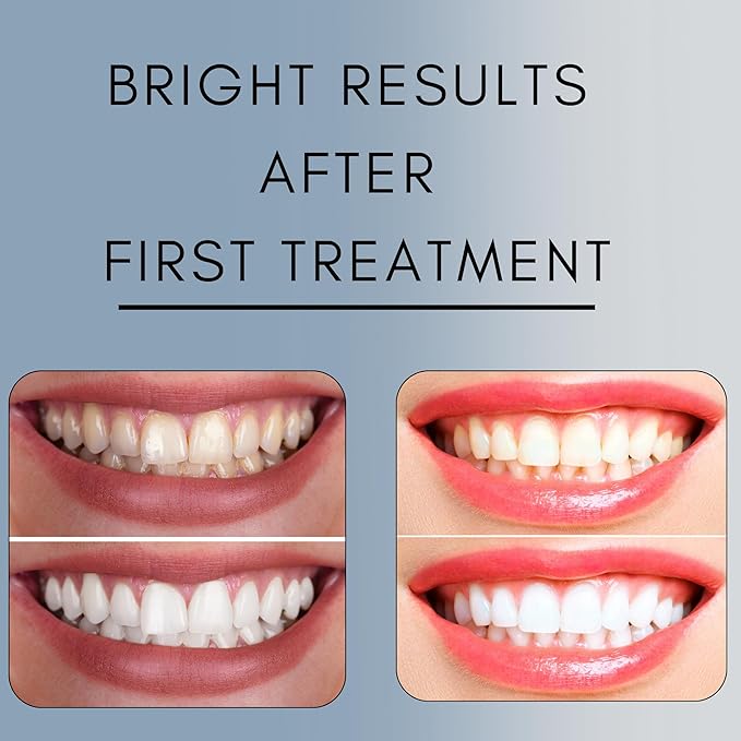 Teeth Whitening Gel Refill for Trays - Professional Strength 44% Carbamide Peroxide Formula - Fast & Effective Bleaching Solution for a Brighter Smile-Ruum Studio Home