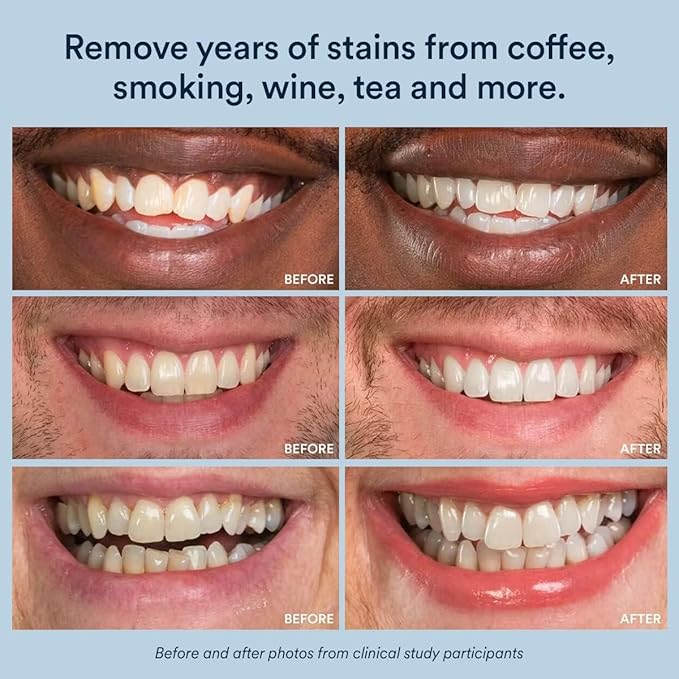 Auraglow Teeth Whitening Strips, Sensitive Whitening Strips, 14 Whitening Treatments, 8% Hydrogen Peroxide with Nano Hydroxyapatite (nHAp) to Reduce Sensitivity and Protect Enamel, 28 Strips, Mint-Ruum Studio Home