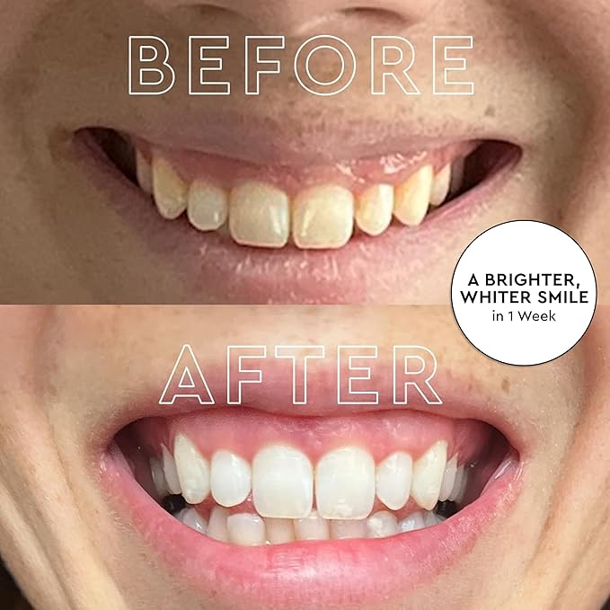 MOON LED Teeth Whitening Kit - Platinum Teeth Whitener Device + 28 Dissolving White Strips - Yellow, Blue, + Red Light Therapy Whitening Tray for Gum Health and Fresh Breath (4 Piece Kit)-Ruum Studio Home