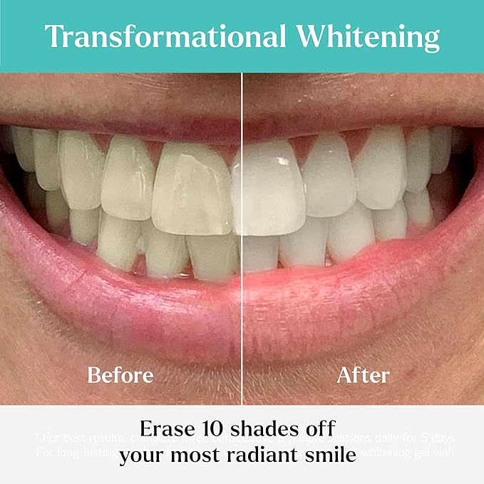 GLO Science So Brilliant Teeth Whitening Kit – Patented Warming Mouthpiece with LED Light Technology, Whitening Gel w/ 6% Hydrogen Peroxide, Lip Balm – Fastest Way to Whiter Teeth, Sensitivity Free-Ruum Studio Home