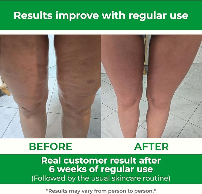 TESMED Cellulite Manual Massager : Made in Italy, Patented with Converging & Diverging Roller Technology. Anti Cellulite Roller for Thighs and Buttock-Ruum Studio Home