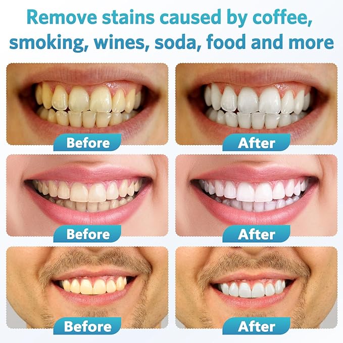 BESTEK Teeth Whitening Kit - 32X LED Teeth Whitening Light, 10 Min Fast Teeth Whitener with 4 Tubes of 35% Carbamide Peroxide Teeth Whitening Gel for Remove Coffee Wine Tobacco Teeth Stains - Blue-Ruum Studio Home