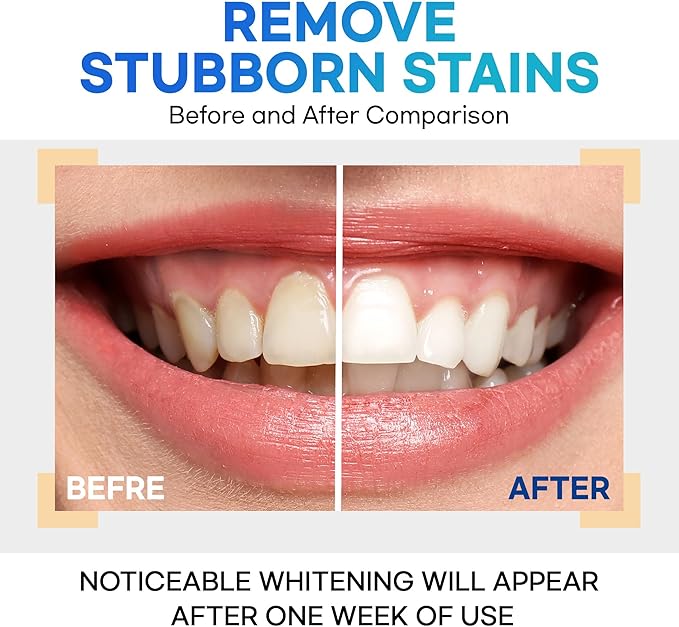 Teeth Whitening Gel – Set of 3 – Gentle, Pain-Free Formula for Sensitive Teeth – Easy, Mess-Free Application – Travel-Friendly & Enamel-Safe for a Brighter Smile-Ruum Studio Home