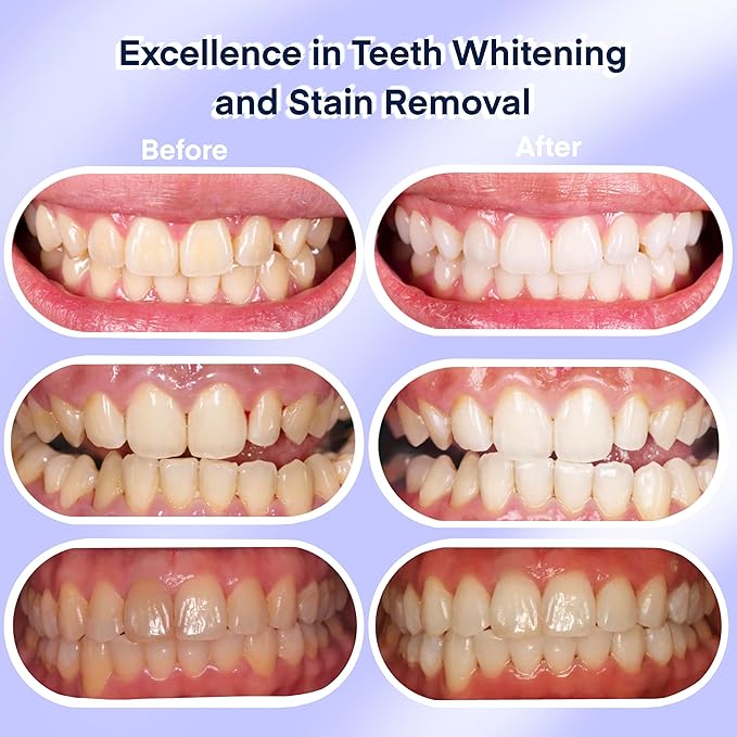 American Teeth Whitening Kit, Teeth Whitening Gel, Pen, Whitening Trays with Light, 25 Uses, Whiten Up to 8 Shades in 1 Week, 2025 Powerful Teeth Whitener-Ruum Studio Home
