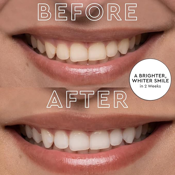 MOON LED Teeth Whitening Kit - Gentle Teeth Whitener Device, 56 White Strips, USB Charger & Travel Case - Blue Light Whitening Tray Removes Stains & Whitens Up to 12 Shades in 2 Weeks (4 Piece Kit)-Ruum Studio Home