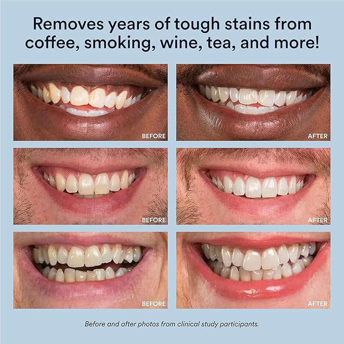 Auraglow Teeth Whitening Kit, LED Accelerator Light, 35% Carbamide Peroxide Teeth Whitening Gel, 20+ Whitening Treatments, Whitens up to 10 Shades in 7 Days-Ruum Studio Home